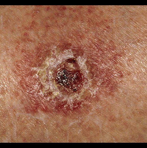 3 предупредителни признака за рак на кожата, които нямат нищо общо с нова или изменена бенка!