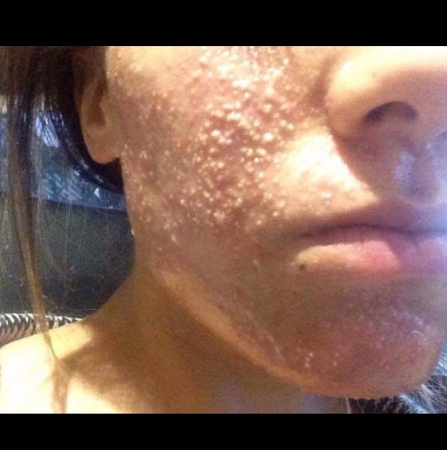 "Лицето ми гореше": Жена се бори с ужасна инфекция след посещение в козметичен салон! Прочетете нейното предупреждение!