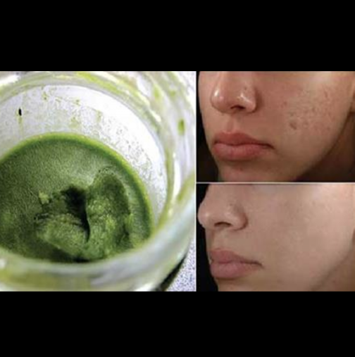 Тази зелена паста ще премахне пъпките и белезите от лицето ви само за 3 дни!