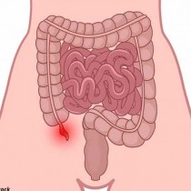 5 признака, че скоро ще ви се спука апандесита