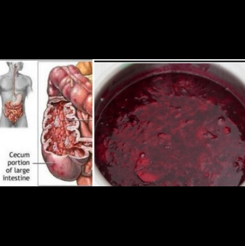 Лекари я препоръчват: Най-добрият естествен лаксатив! Отцедете дебелото черво и излишните течности!