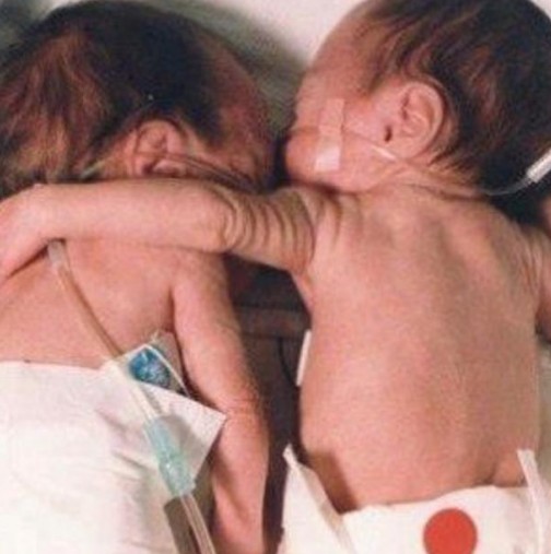 Невероятно чудо преди 18 години-Тази прегръдка завинаги промени медицината-Ето как изглеждат днес!
