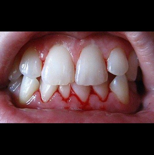 Само за 3 дни успях да спра кървенето на венците с тези домашни средства,  зъболекарката не можа да повярва като ме видя
