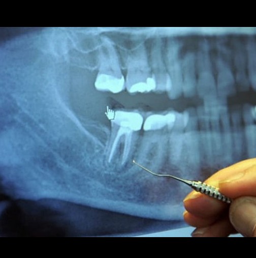 Нови шокиращи резултати: 97% от хората с рак и други сериозни заболявания, са имали тази процедура на зъбите