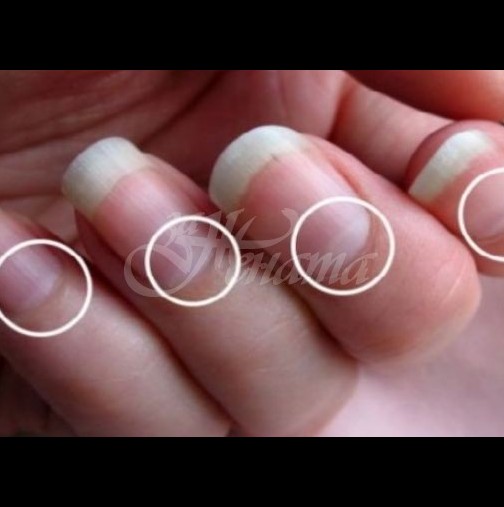 Предупредителен знак: Ако нямате полумесец на някой от ноктите си, това е важен сигнал