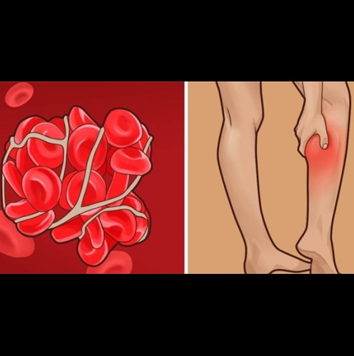 6 общи признака на тромбоза - това са симптомите, които не бива да пренебрегвате!