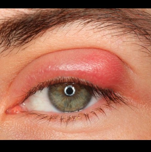 Бабини лекове, с които веднага ще премахнете ечемика на окото. 8 изпитани рецепти