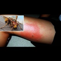 Добре е да знаете: Ако Ви ужили оса, стършел или пчела - това ще Ви спести болката и подуването!