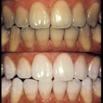 Зъболекарката ми е приятелка и ми сподели страшна рецепта за домашна избелваща паста, зъбите стават с 3 цвята по-бели