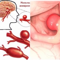 Тихи и коварни, могат да ви съсипят здравето, но ето как да разпознаете опасността от съдови аневризми