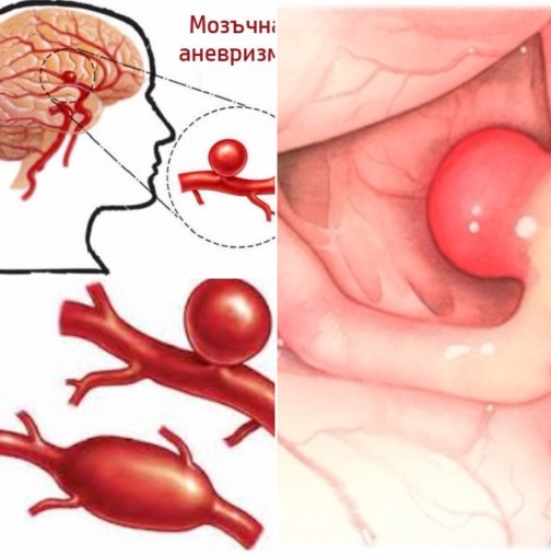 Тихи и коварни, могат да ви съсипят здравето, но ето как да разпознаете опасността от съдови аневризми