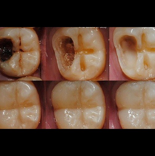 Запазване на зъбите от кариес в няколко стъпки
