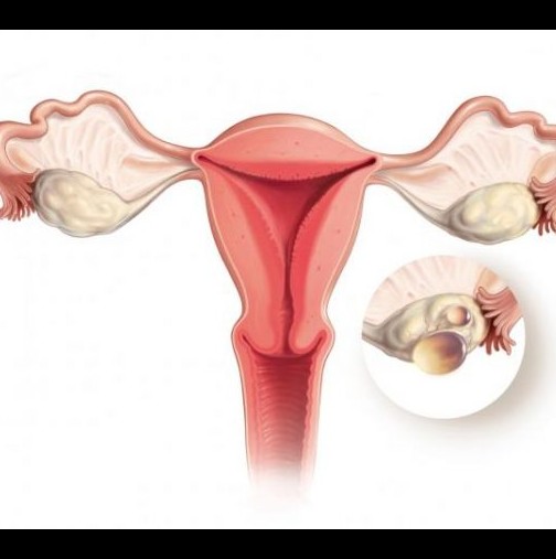 Учените на прага да открият лекарство срещу рак на яйчниците
