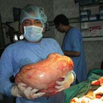 Извадиха огромен тумор с тегло 50 кг от корема на жена!