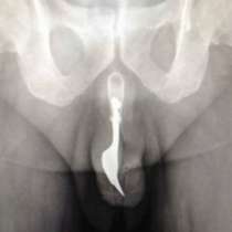 Лекари извадиха 10-сантиметрова вилица от пениса на 70-годишен мъж