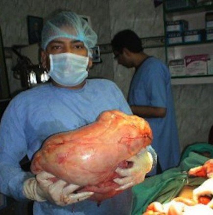 Извадиха огромен тумор с тегло 50 кг от корема на жена!