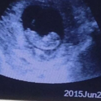 Снимка, спираща дъха: Видяха това при ултразвук близо до бебето!