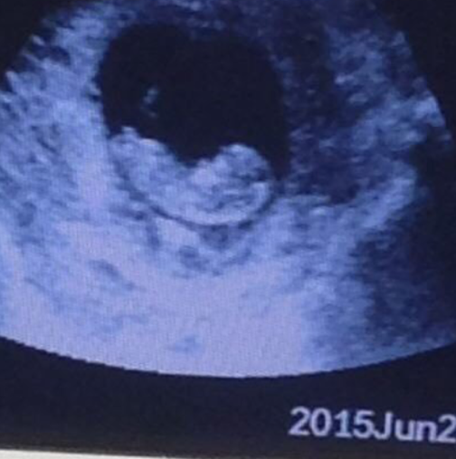 Снимка, спираща дъха: Видяха това при ултразвук близо до бебето!