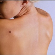 Учени откриха причинителя на рак на кожата 