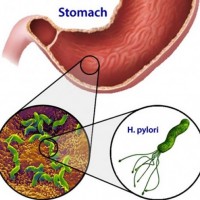 Как да се отървете от Helicobacter pylori без хапчета