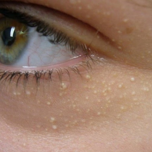 Имате ли бели точки под очите или лицето -Лесно можете да се отървете от тях с няколко съставки
