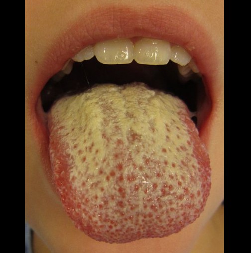 Как да премахнете белите налепи по езика си най- лесно и да отстраните лошия дъх и микроби