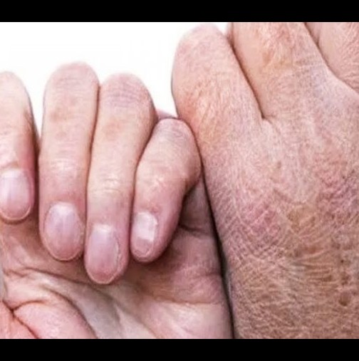 Познайте първите симптоми на рак по дланите