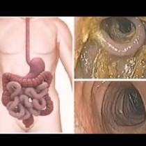 48-часов детокс, три органа участват в него-Едновременно пречистване на черния дроб, бъбреците, дебелото черво измита всичко отровно