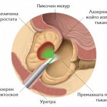 Най-честата причина за рак на простатата