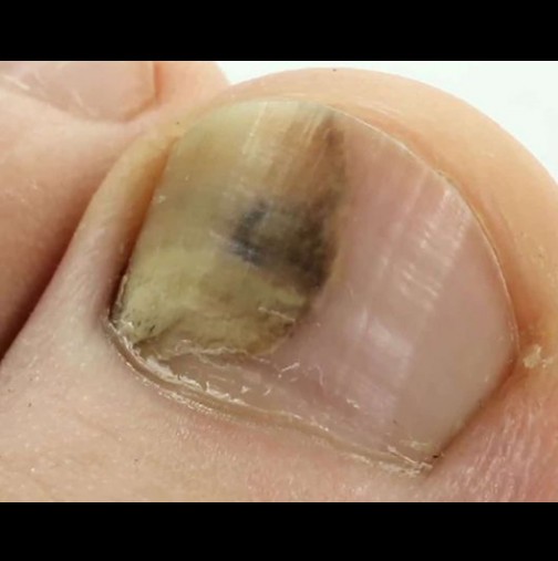 Важно предупреждение: Повечето хора не знаят, че имат гъбички на ноктите! Ето как да се отървете лесно, преди да се влоши