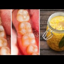 Как да се отървем от кариеса по естествен начин с 3 прости и ефективни средства за домашно лечение. Вашите зъби ще бъдат благодарни!