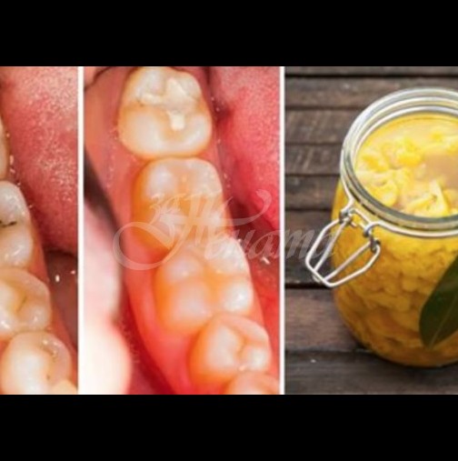 Как да се отървем от кариеса по естествен начин с 3 прости и ефективни средства за домашно лечение. Вашите зъби ще бъдат благодарни!