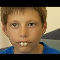 Операция по коригиране на зъби