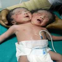 ВИДЕО: Индийка роди бебе с две глави