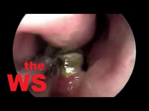 Зъб расте в носа на човек