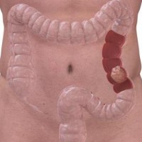 Рискове за рак на дебелото черво