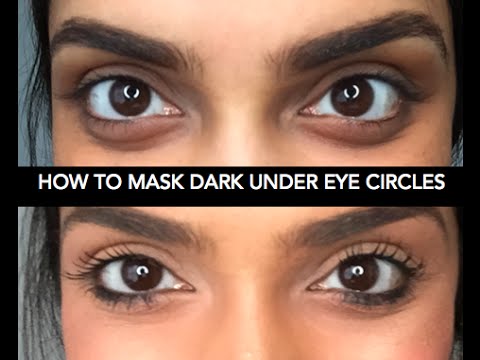 Как да премахна бързо тъмните кръгове под очите?