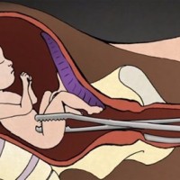 Как се прави аборт