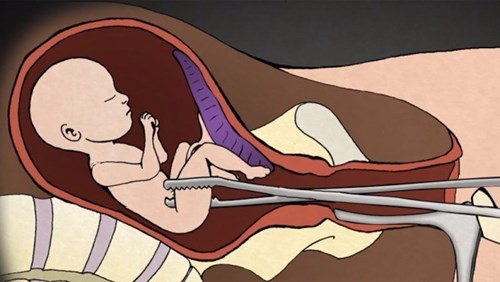 Как се прави аборт